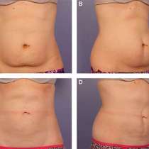 Коррекция фигуры, в Москве