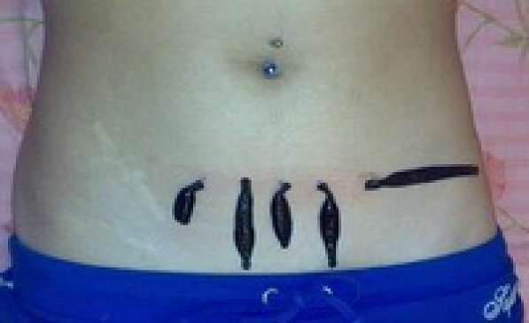 КОМПЛЕКСНАЯ ГИРУДОТЕРАПИЯ в Ейске фото 3