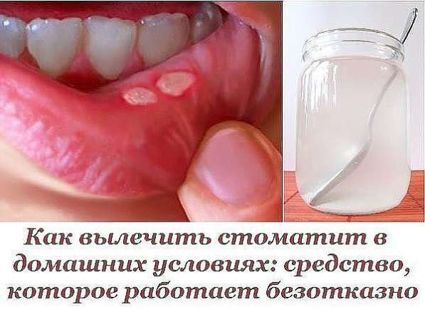 Как быстро вылечить стоматит