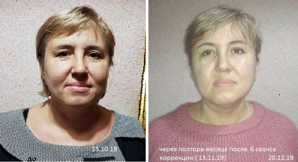 Массаж-Омоложение лица и шеи- Витапластика в Краснодаре фото 4
