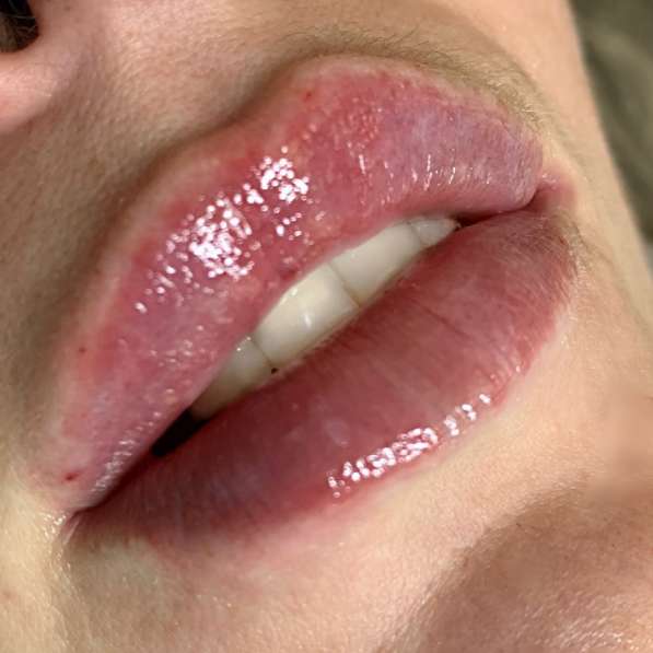 Увеличение губ в Мытищи фото 9